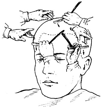 Рис. 78. Схема технологического процесса бритья волос лицевой части головы по первому разу